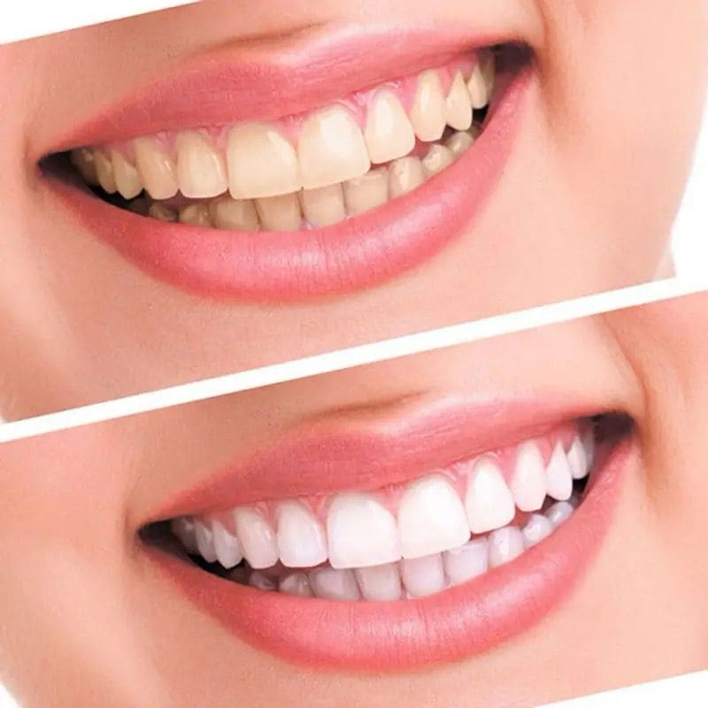 Whiteness Perfect - Clareador Dental 22% 6 Unidades